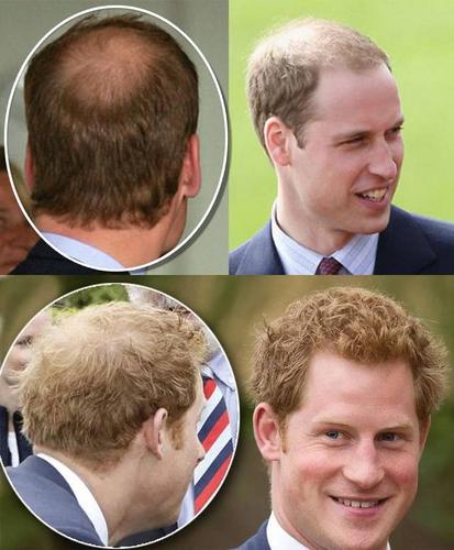 为什么在英国留学秃头-英国男人秃头原因？